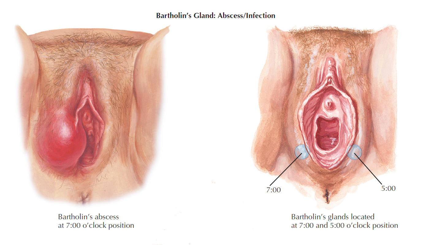 barthoyns gland and abscess